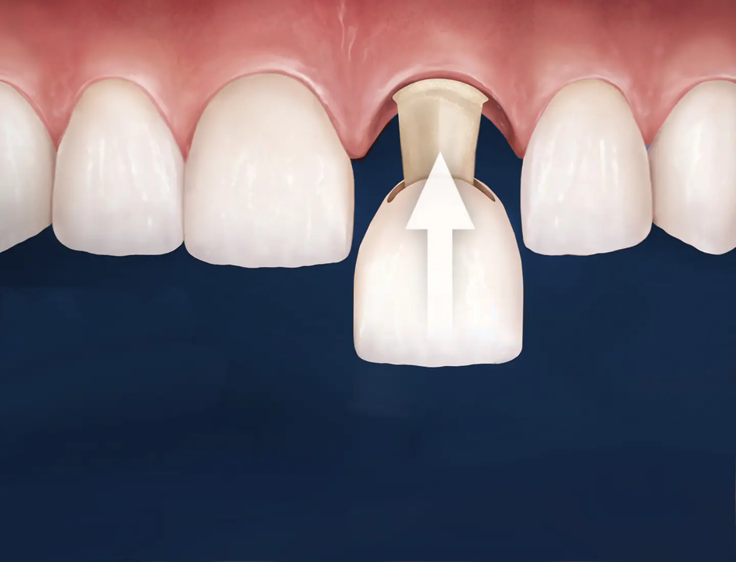 How Dental Crowns in Torquay are placed