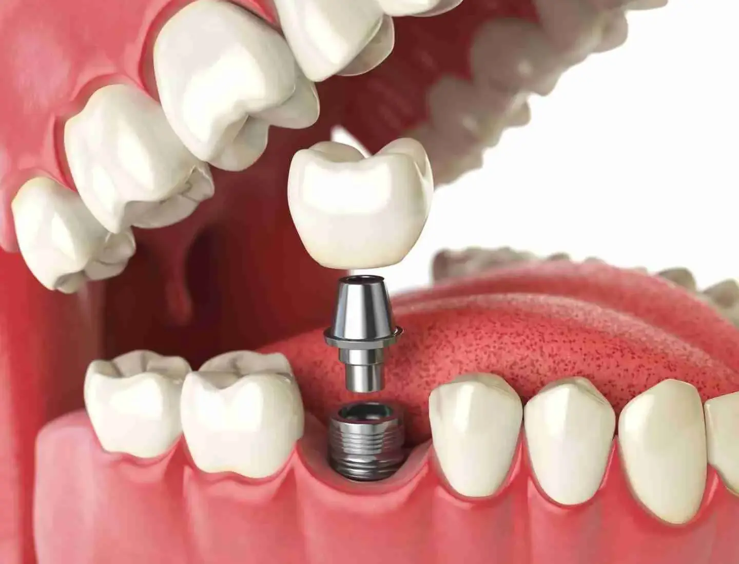 Dental Implants in Torquay