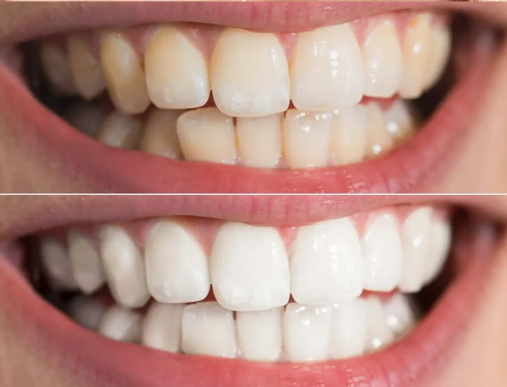 Teeth Whitening In Torquay