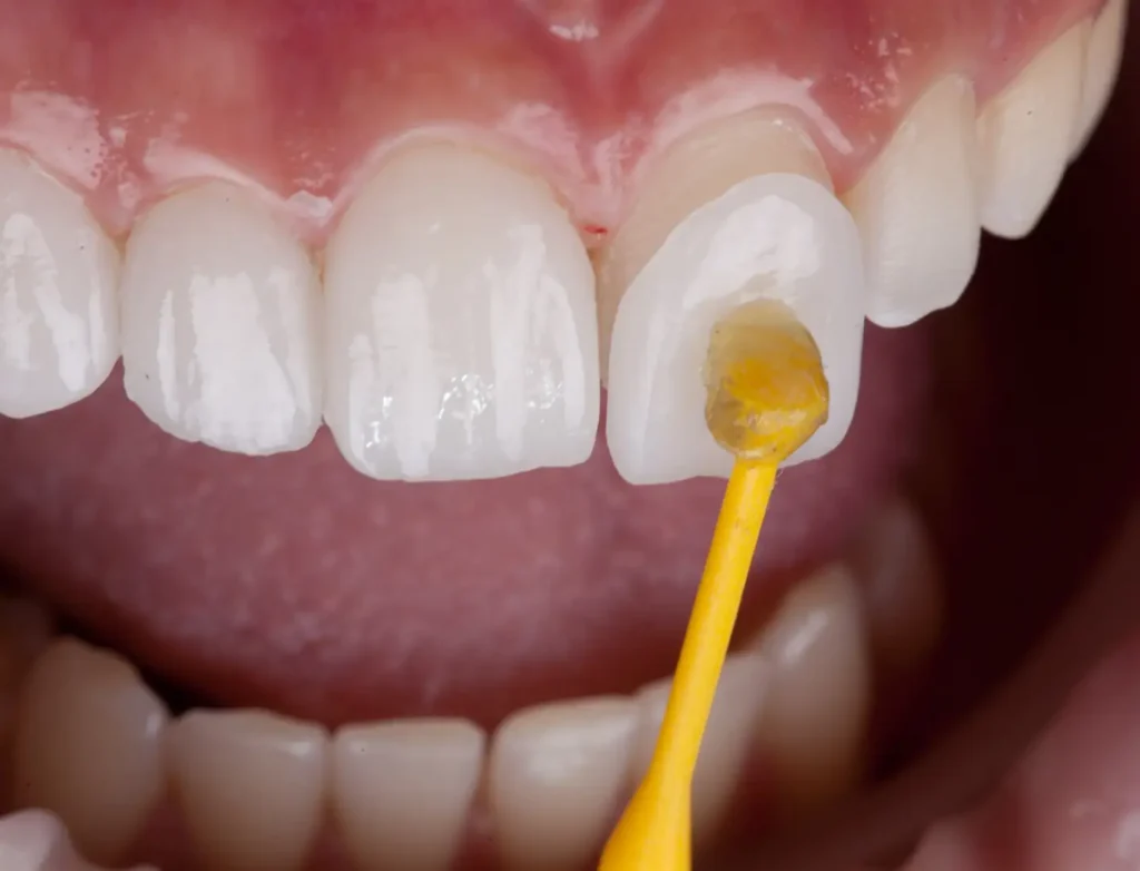 Tooth Veneers in Torquay